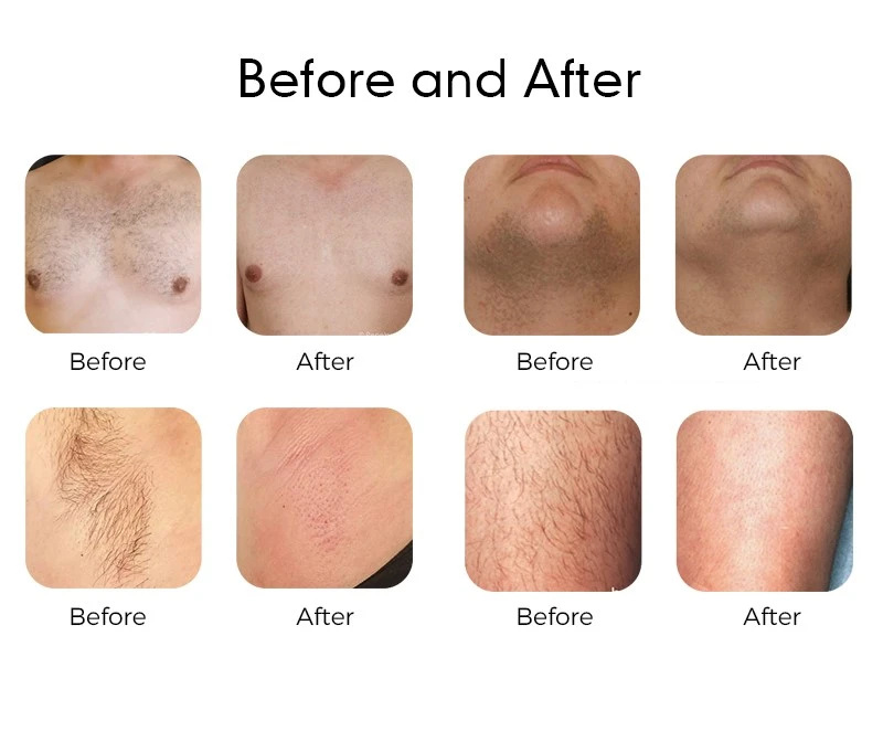 Hair-removal treatment examples
