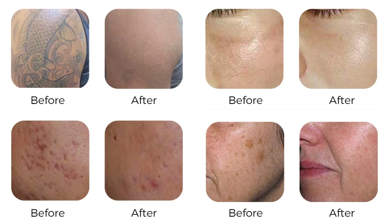 Picosecond laser treatment profile