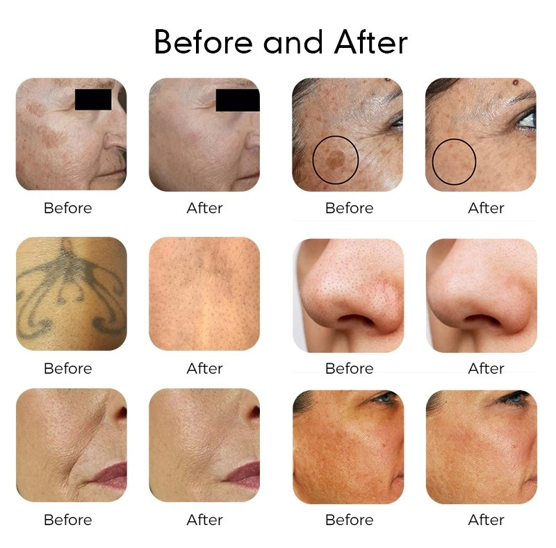 VALO ChronoQ treatment examples